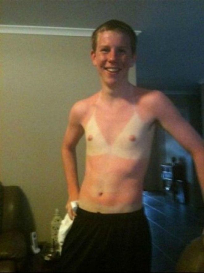 Как не стоит загорать 23 фото