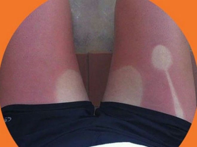 Как не стоит загорать 23 фото