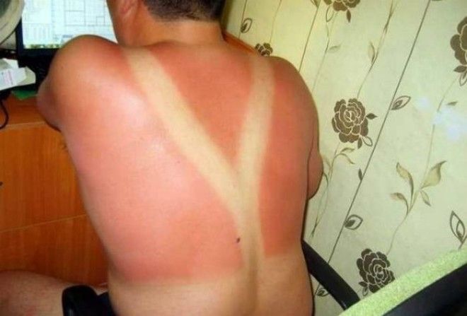 Как не стоит загорать 23 фото