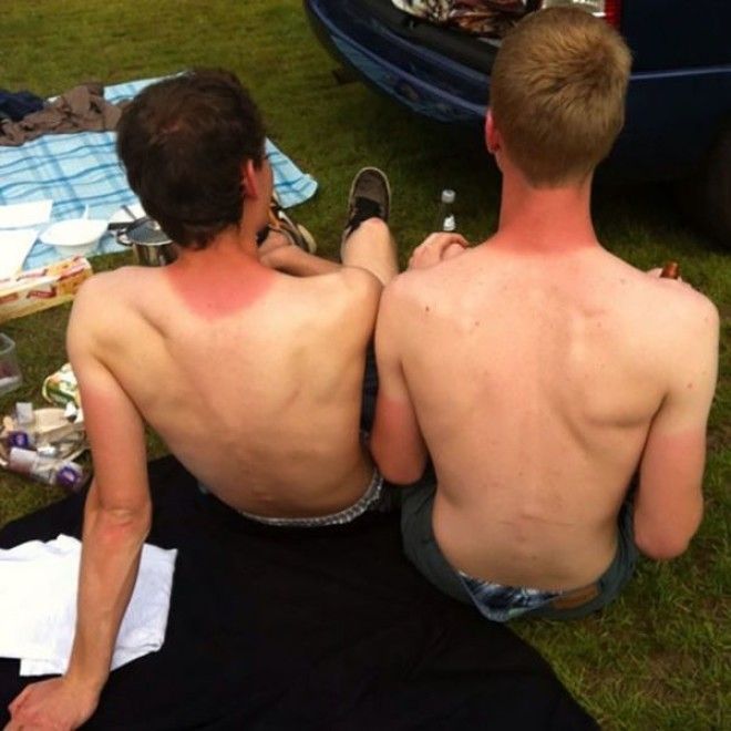 Как не стоит загорать 23 фото