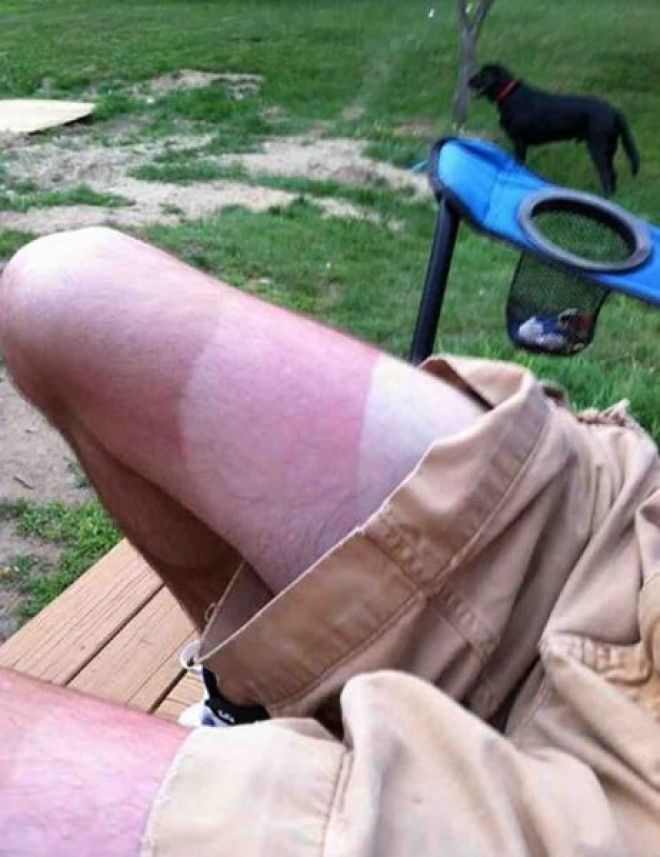 Как не стоит загорать 23 фото