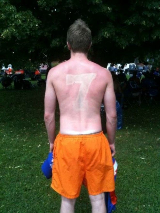 Как не стоит загорать 23 фото