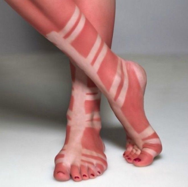 Как не стоит загорать 23 фото