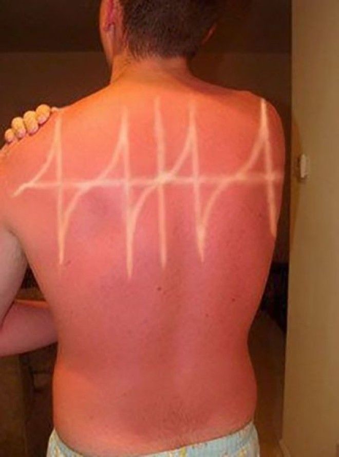 Как не стоит загорать 23 фото