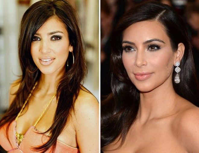 10 знаменитостей которым пластика явно пошла на пользу