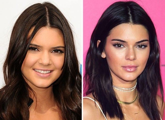 10 знаменитостей которым пластика явно пошла на пользу