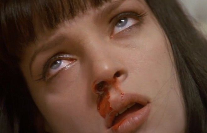 Ошибка запрокидывать голову во время кровотечения из носа